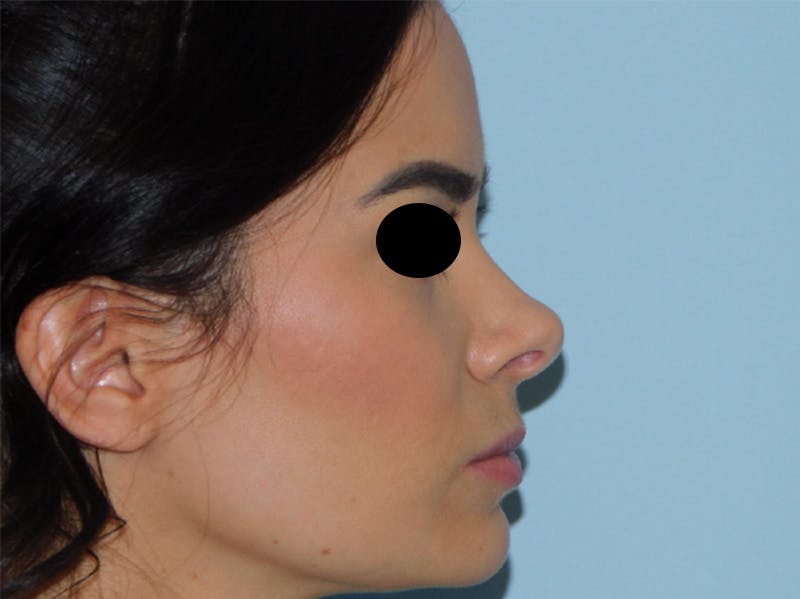 Rhinoplasty Before & After Gallery - Patient 133066378 - Image 1