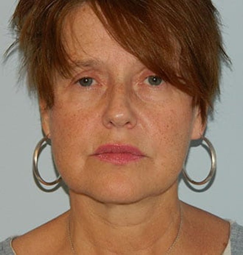 Mini-Facelift Before & After Gallery - Patient 133066376 - Image 1