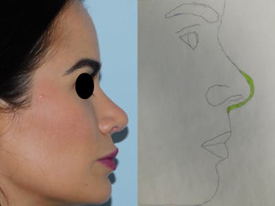 Rhinoplasty Before & After Gallery - Patient 133066378 - Image 2