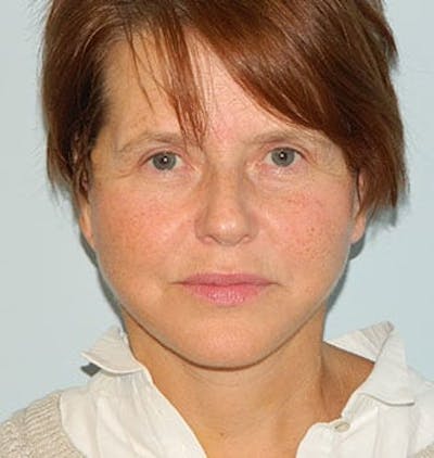 Mini-Facelift Before & After Gallery - Patient 133066376 - Image 2