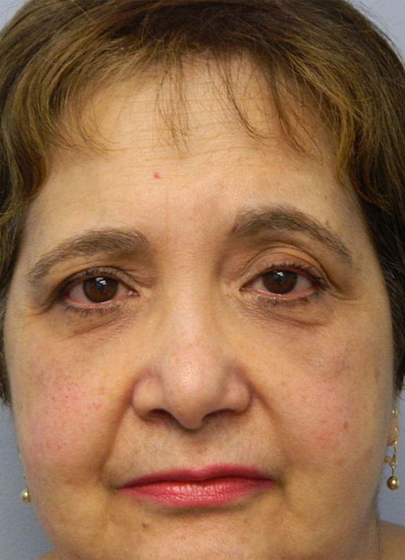 Brow Lift Before & After Gallery - Patient 133066375 - Image 1