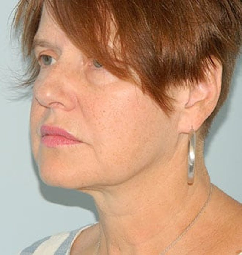 Mini-Facelift Before & After Gallery - Patient 133066376 - Image 3