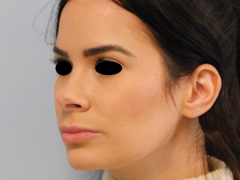Rhinoplasty Before & After Gallery - Patient 133066378 - Image 3