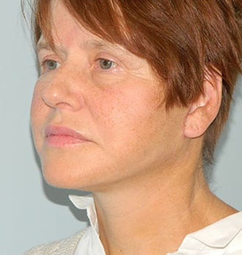 Mini-Facelift Before & After Gallery - Patient 133066376 - Image 4