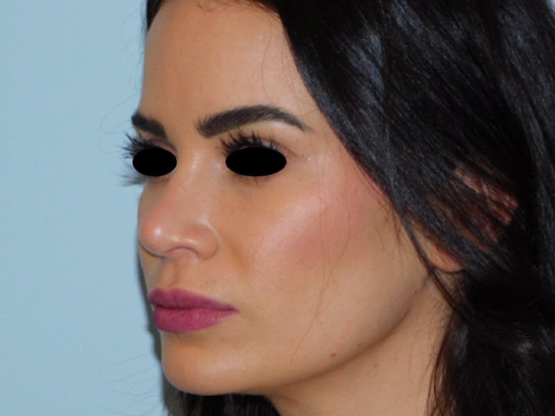 Rhinoplasty Before & After Gallery - Patient 133066378 - Image 4