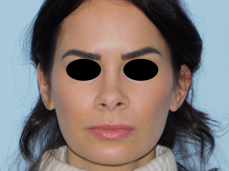 Rhinoplasty Before & After Gallery - Patient 133066378 - Image 5