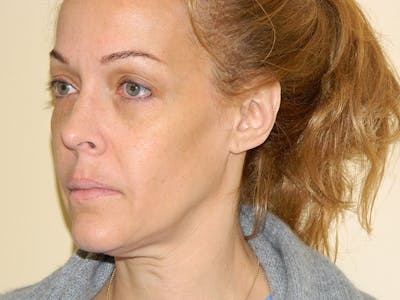Mini-Facelift Before & After Gallery - Patient 133066379 - Image 1