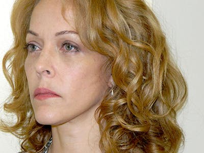 Mini-Facelift Before & After Gallery - Patient 133066379 - Image 2