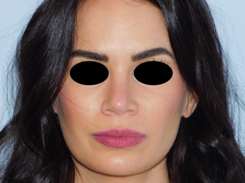 Rhinoplasty Before & After Gallery - Patient 133066378 - Image 6