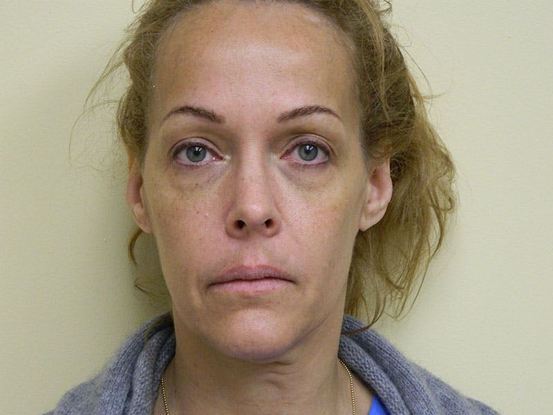 Mini-Facelift Before & After Gallery - Patient 133066379 - Image 3