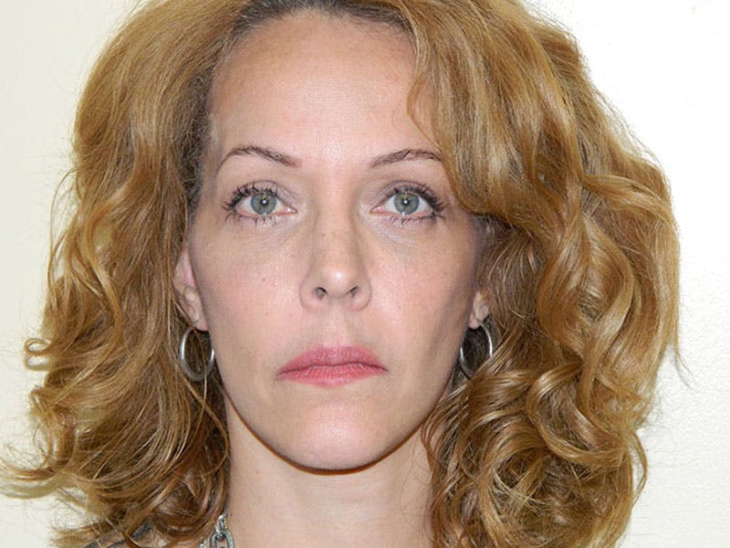 Mini-Facelift Before & After Gallery - Patient 133066379 - Image 4