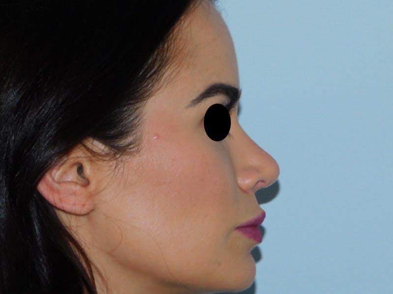 Rhinoplasty Before & After Gallery - Patient 133066378 - Image 8