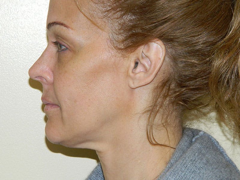 Mini-Facelift Before & After Gallery - Patient 133066379 - Image 5