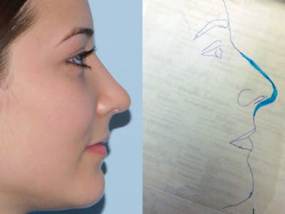 Rhinoplasty Before & After Gallery - Patient 133066384 - Image 2