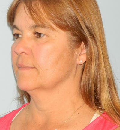 Mini-Facelift Before & After Gallery - Patient 133066385 - Image 1