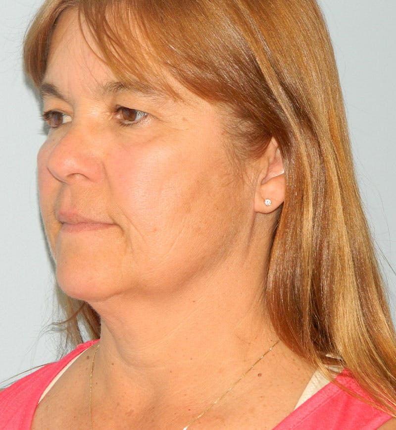 Mini-Facelift Before & After Gallery - Patient 133066385 - Image 1