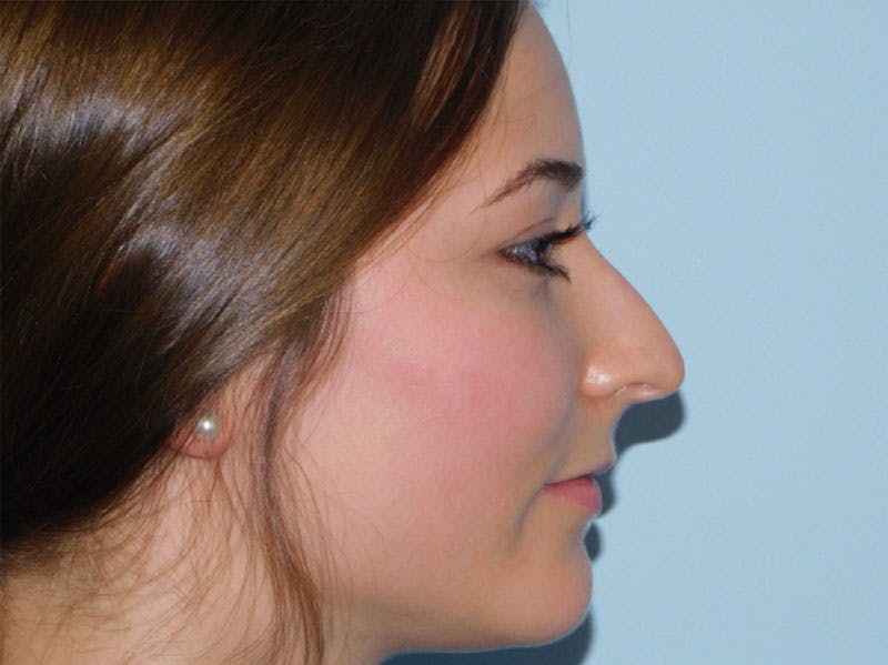 Rhinoplasty Before & After Gallery - Patient 133066384 - Image 3