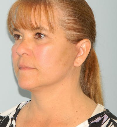 Mini-Facelift Before & After Gallery - Patient 133066385 - Image 2