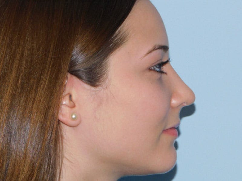 Rhinoplasty Before & After Gallery - Patient 133066384 - Image 4