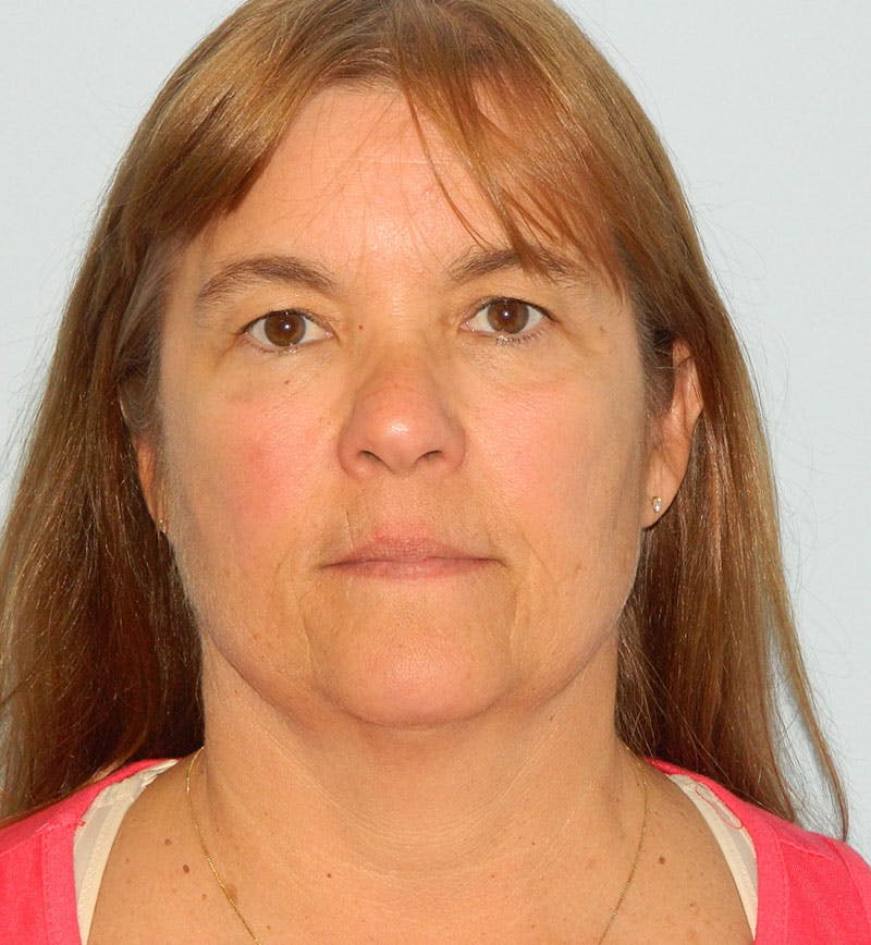 Mini-Facelift Before & After Gallery - Patient 133066385 - Image 3