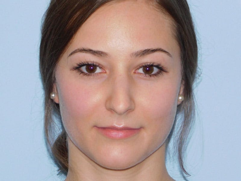Rhinoplasty Before & After Gallery - Patient 133066384 - Image 5