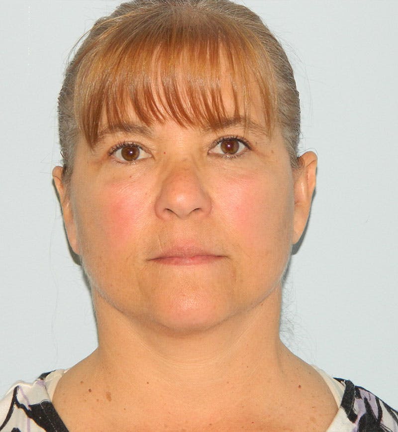 Mini-Facelift Before & After Gallery - Patient 133066385 - Image 4
