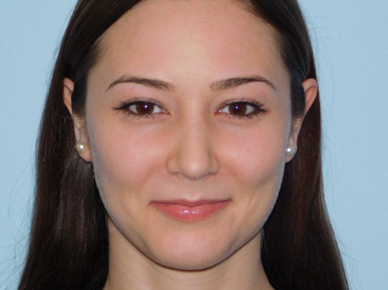 Rhinoplasty Before & After Gallery - Patient 133066384 - Image 6