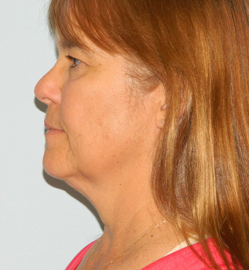 Mini-Facelift Before & After Gallery - Patient 133066385 - Image 5