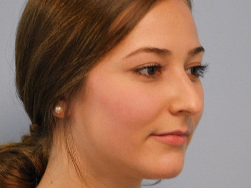 Rhinoplasty Before & After Gallery - Patient 133066384 - Image 7
