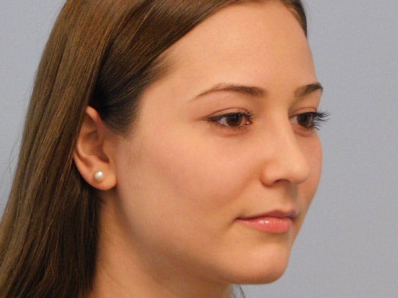 Rhinoplasty Before & After Gallery - Patient 133066384 - Image 8