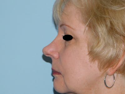 Rhinoplasty Before & After Gallery - Patient 133066390 - Image 1