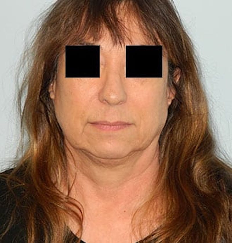Mini-Facelift Before & After Gallery - Patient 133066386 - Image 1