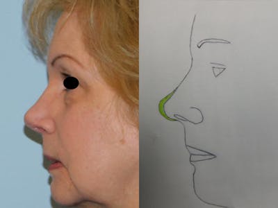 Rhinoplasty Before & After Gallery - Patient 133066390 - Image 2