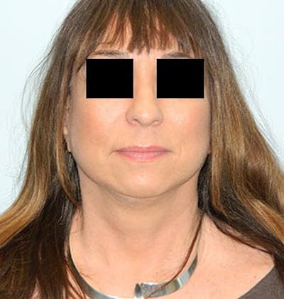 Mini-Facelift Before & After Gallery - Patient 133066386 - Image 2