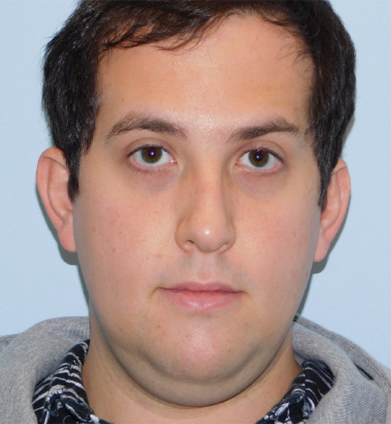 Neck (Submental) Liposuction Before & After Gallery - Patient 133066387 - Image 1