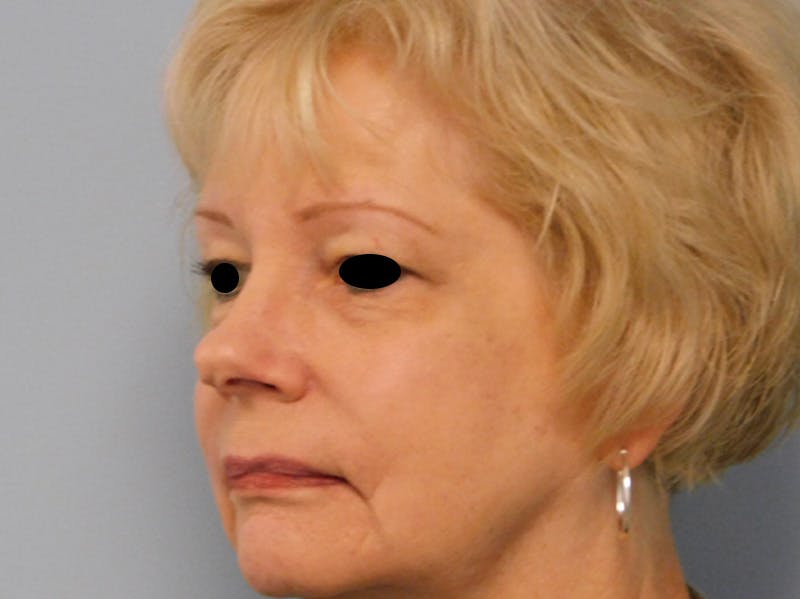Rhinoplasty Before & After Gallery - Patient 133066390 - Image 3