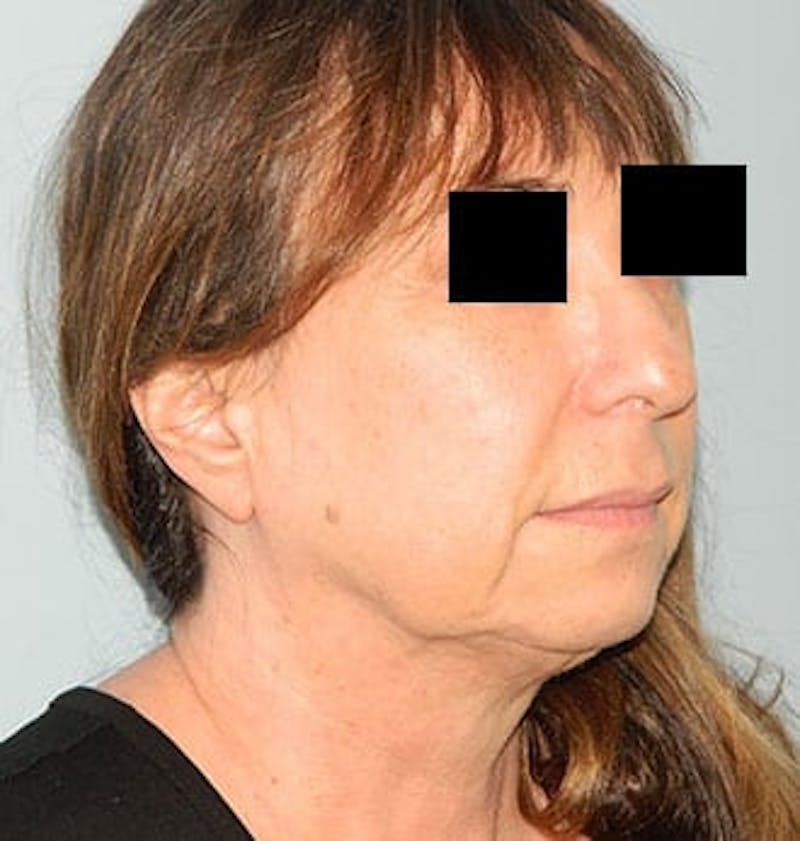 Mini-Facelift Before & After Gallery - Patient 133066386 - Image 3