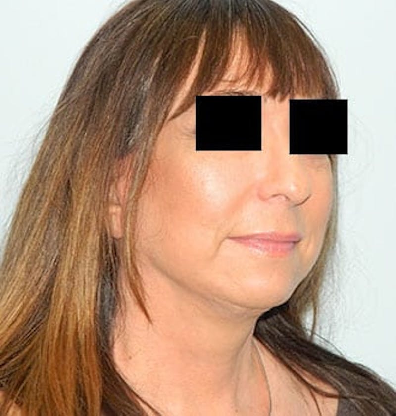 Mini-Facelift Before & After Gallery - Patient 133066386 - Image 4