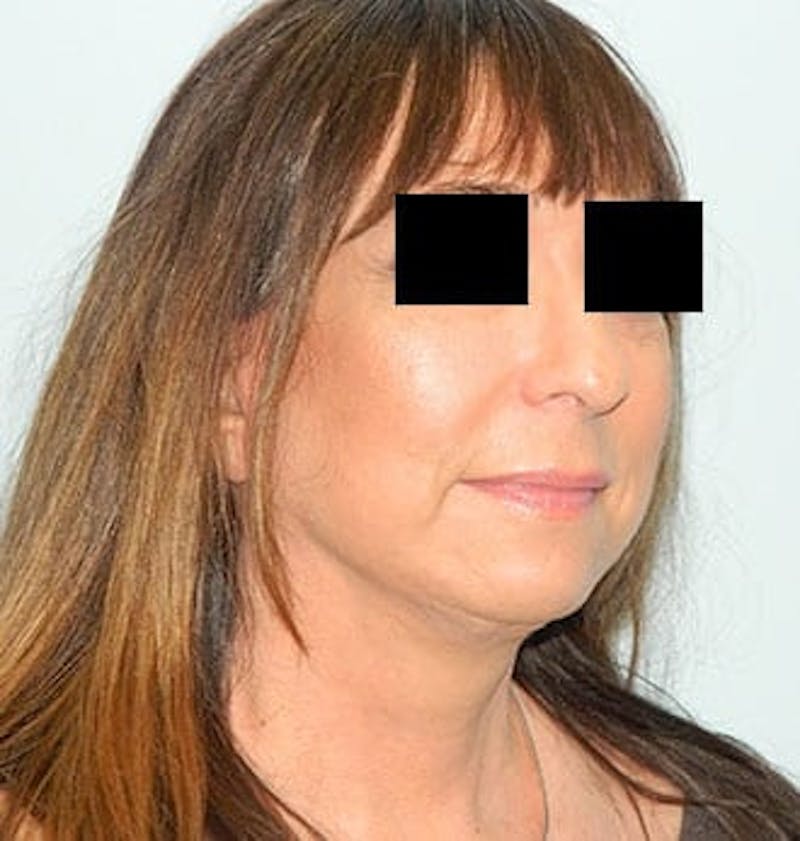 Mini-Facelift Before & After Gallery - Patient 133066386 - Image 4