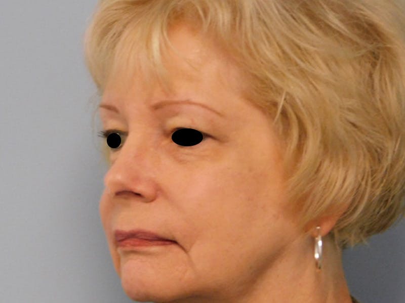 Rhinoplasty Before & After Gallery - Patient 133066390 - Image 4