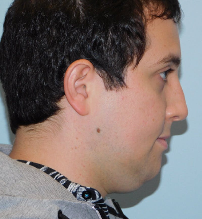 Neck (Submental) Liposuction Before & After Gallery - Patient 133066387 - Image 3