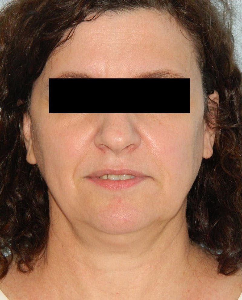 Mini-Facelift Before & After Gallery - Patient 133066389 - Image 1