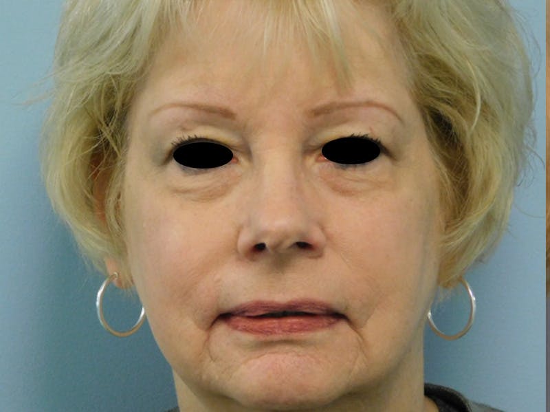 Rhinoplasty Before & After Gallery - Patient 133066390 - Image 5