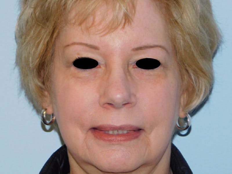 Rhinoplasty Before & After Gallery - Patient 133066390 - Image 6