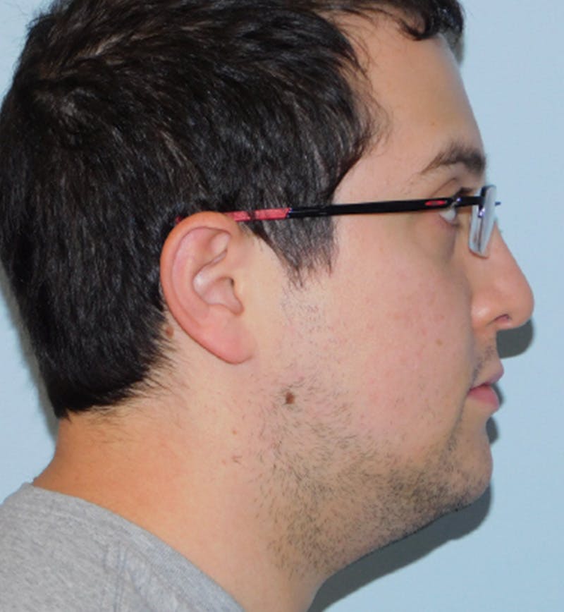 Neck (Submental) Liposuction Before & After Gallery - Patient 133066387 - Image 4