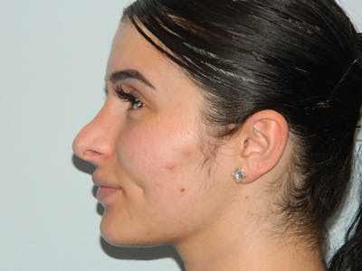 Revision Rhinoplasty Before & After Gallery - Patient 133066393 - Image 1