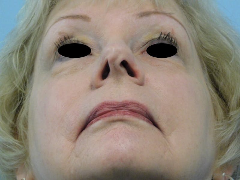 Rhinoplasty Before & After Gallery - Patient 133066390 - Image 7