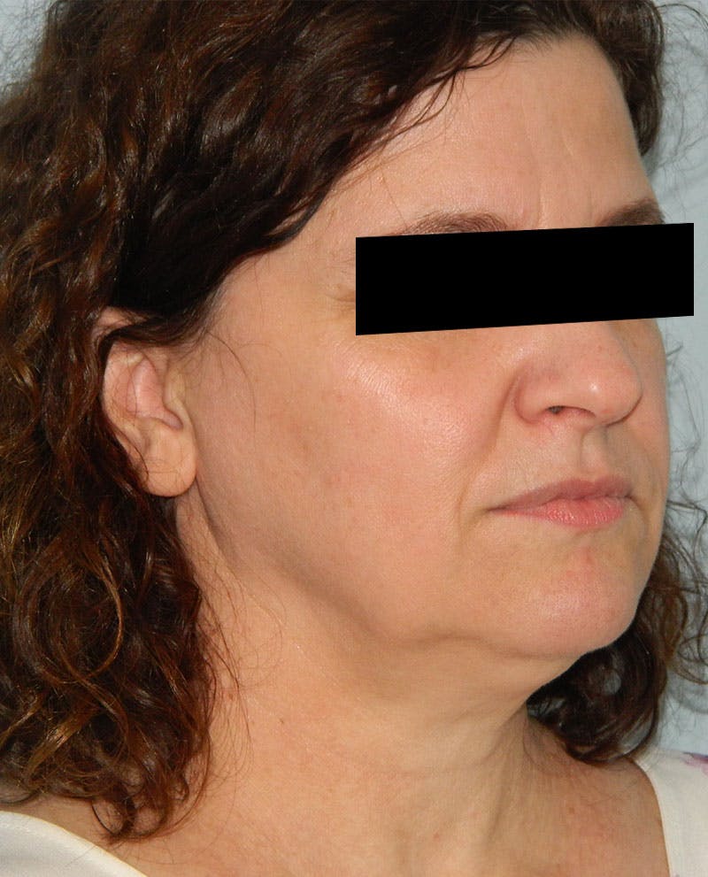 Mini-Facelift Before & After Gallery - Patient 133066389 - Image 3