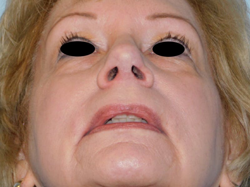 Rhinoplasty Before & After Gallery - Patient 133066390 - Image 8