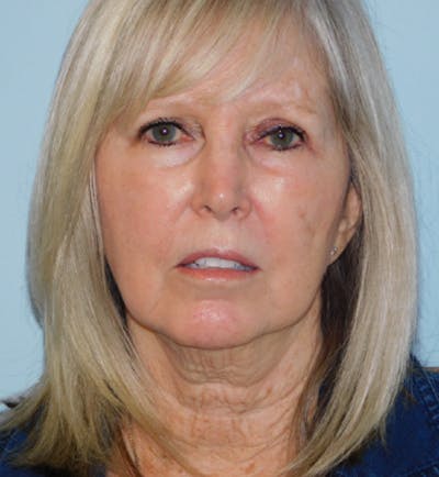 Mini-Facelift Before & After Gallery - Patient 133066392 - Image 1